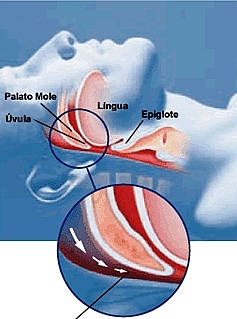 PRIMEIRO ELETROESTIMULADOR PARA TRATAMENTO DA APNEIA FOI IMPLANTADO NO BRASIL
